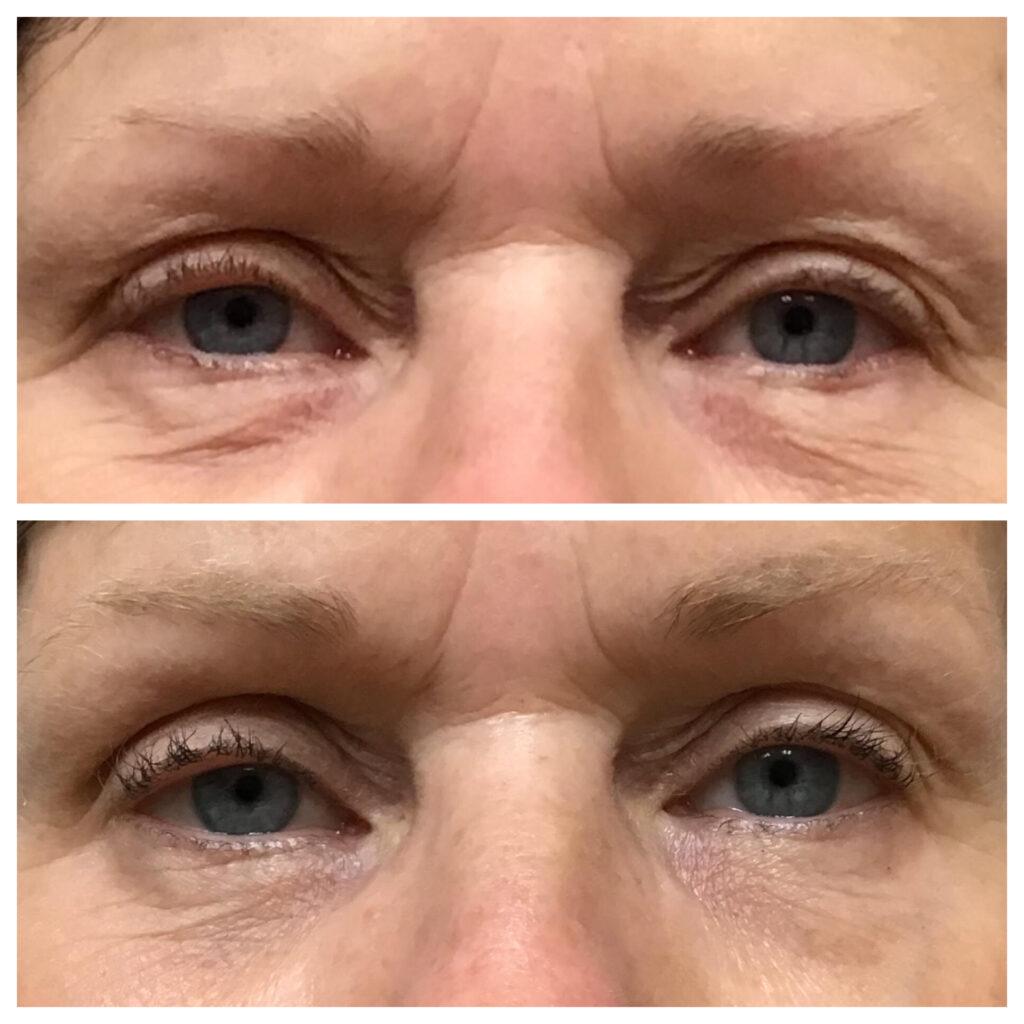 before and after